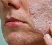 DIY Face Masks for Acne Scars